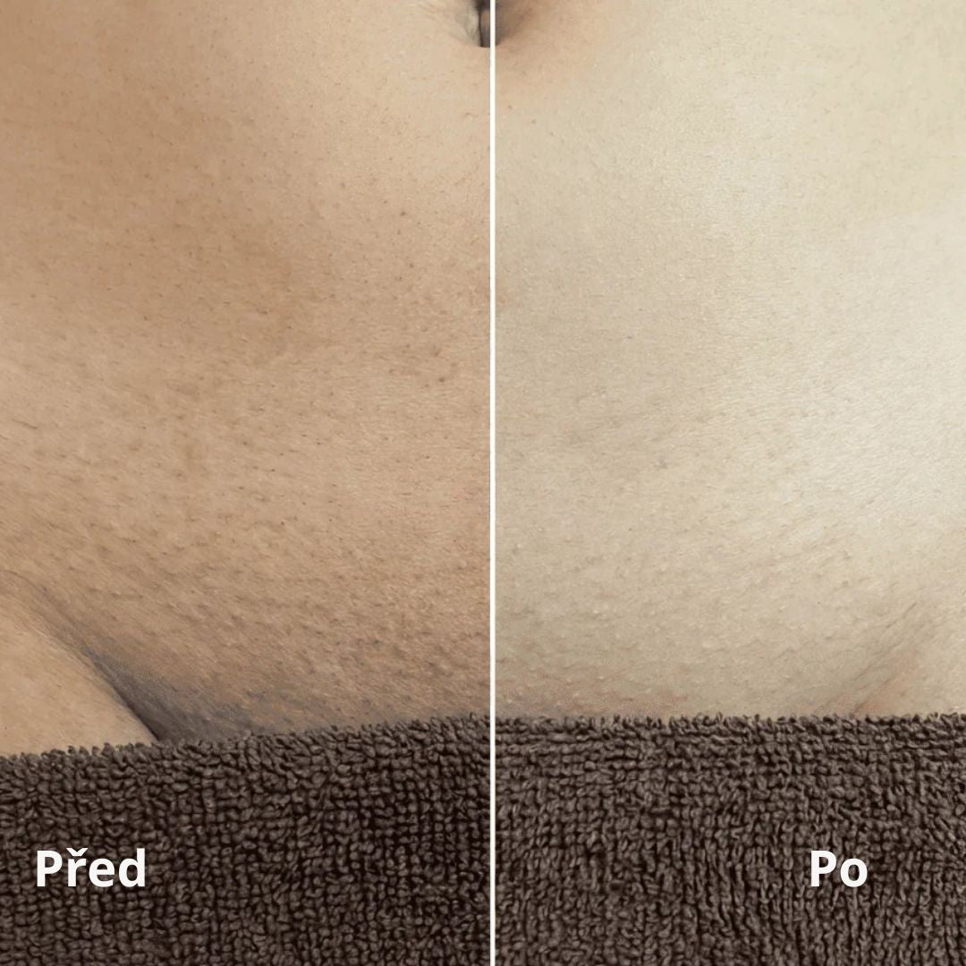 Lorvea Cyperus — Olej proti růstu chloupků